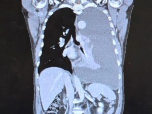 Pleural effusion Gary Lee